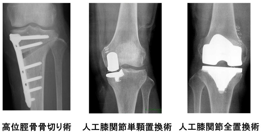 変形性膝関節症の手術療法／人工膝関節置換術と膝周囲骨切り術 | 医療 